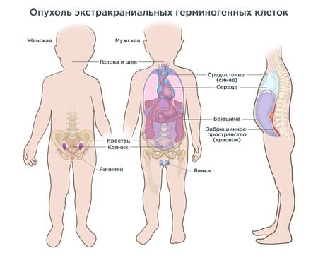 Герминогенные опухоли (внечерепные)